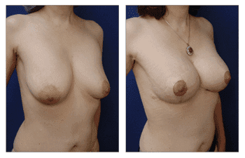Breast Lift With Implant Augmentation Southern Orange County; CPSI, width: 350px; height: 225px; Breast Lift With Implant Augmentation Southern Orange County; CPSI, width: 350px; height: 225px;