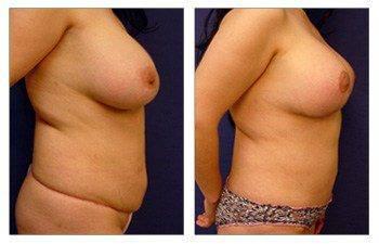 breast-lift-with-implant-augmentation-patient-11-right(1)