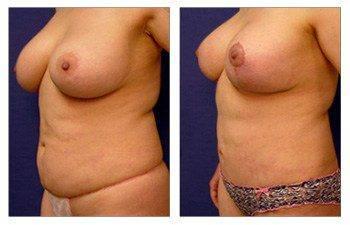 Breast Lift with Implant Augmentation Revision Newport Beach Breast Lift with Implant Augmentation Revision Newport Beach
