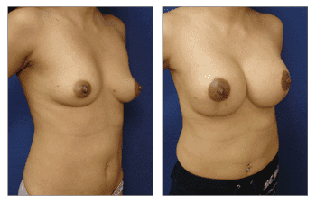 Breast Lift With Implant Augmentation Southern California; CPSI, width: 350px; height: 225px; Breast Lift With Implant Augmentation Southern California; CPSI, width: 350px; height: 225px;