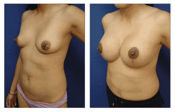 Breast Lift With Implant Augmentation Southern California; CPSI, width: 350px; height: 225px; Breast Lift With Implant Augmentation Southern California; CPSI, width: 350px; height: 225px;