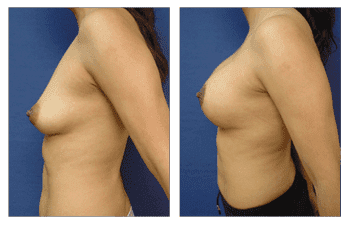 Breast Lift With Implant Augmentation Southern California; CPSI, width: 350px; height: 225px; Breast Lift With Implant Augmentation Southern California; CPSI, width: 350px; height: 225px;