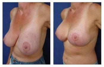 Breast Lift With Implant Augmentation To Correct Breast Deformity, CPSI, width: 350px; height: 225px; Breast Lift With Implant Augmentation To Correct Breast Deformity, CPSI, width: 350px; height: 225px;