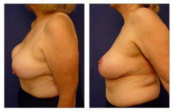 left view Breast Lift With Implant Augmentation To Correct Capsular Contracture left view Breast Lift With Implant Augmentation To Correct Capsular Contracture