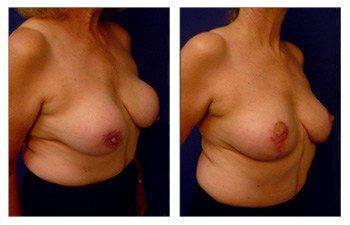 Breast Lift With Implant Augmentation To Correct Capsular Contracture