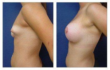 breast-lift-with-implant-augmentation-patient-17-left(1) breast-lift-with-implant-augmentation-patient-17-left(1)