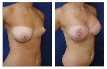 breast-lift-with-implant-augmentation-patient-17-front-right(1) breast-lift-with-implant-augmentation-patient-17-front-right(1)