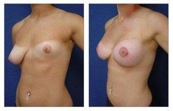 Breast Lift with Implant Augmentation Newport Beach Breast Lift with Implant Augmentation Newport Beach