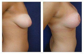 Breast Lift with Implant Augmentation to Correct Congenital Breast Deformity; CPSI, width: 350px; height: 225px; Breast Lift with Implant Augmentation to Correct Congenital Breast Deformity; CPSI, width: 350px; height: 225px;