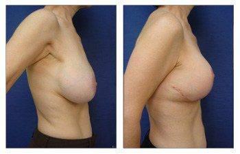 Breast Lift With Implant Augmentation To Decrease Areola Size, CPSI, width: 350px; height: 225px; Breast Lift With Implant Augmentation To Decrease Areola Size, CPSI, width: 350px; height: 225px;