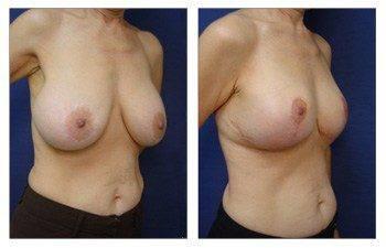 right front oblique Breast Lift With Implant Augmentation To Decrease Areola Size right front oblique Breast Lift With Implant Augmentation To Decrease Areola Size