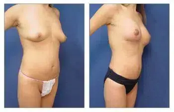 Tummy tuck and breast lift with implant augmentation before and after. Tummy tuck and breast lift with implant augmentation before and after.