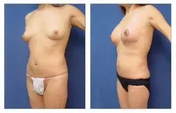 Before and after tummy tuck with breast lift to increase breast mound size. Before and after tummy tuck with breast lift to increase breast mound size.