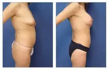 Tummy tuck before and after combined with breast lift and implant augmentation to increase breast mound size. Tummy tuck before and after combined with breast lift and implant augmentation to increase breast mound size.