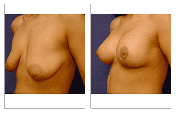 breast-lift-with-implant-augmentation-patient-14-front-left breast-lift-with-implant-augmentation-patient-14-front-left