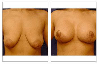 breast-lift-with-implant-augmentation-patient-14-front breast-lift-with-implant-augmentation-patient-14-front