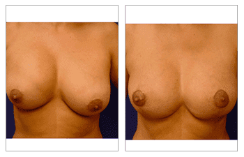Breast Enhancement San Diego - Correct Nipple Position Asymmetry procedure Breast Enhancement San Diego - Correct Nipple Position Asymmetry procedure