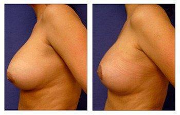 breast-lift-with-implant-augmentation-patient-13-left(1) breast-lift-with-implant-augmentation-patient-13-left(1)