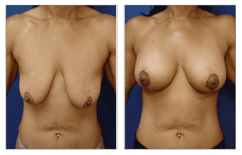 A woman's breasts before and after Breast Lift surgery. A woman's breasts before and after Breast Lift surgery.