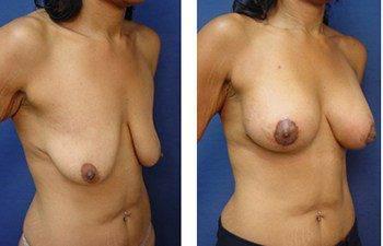 Before and after surgery image - Breast lift with implants cost Before and after surgery image - Breast lift with implants cost
