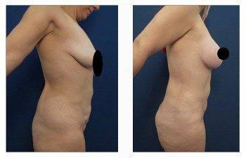 breast lift with implants patient 2 right view breast lift with implants patient 2 right view