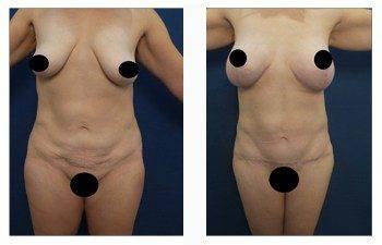 breast lift with implants patient 2 front view breast lift with implants patient 2 front view