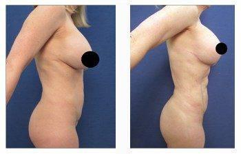breast lift with implants patient 1 front view breast lift with implants patient 1 front view
