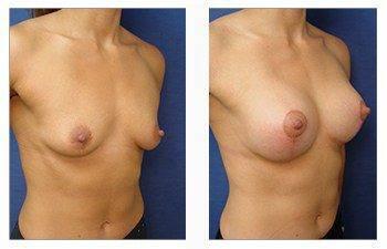 breast lift with implants patient 33 front right view breast lift with implants patient 33 front right view