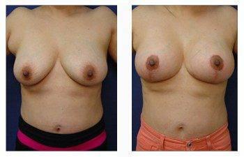 breast lift with implants patient 34 front left view breast lift with implants patient 34 front left view