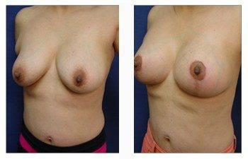 breast lift with implants patient 34 front left view breast lift with implants patient 34 front left view