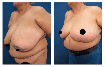 Before and after pictures of a woman's breast augmentation surgery.