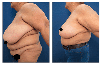 A woman's chest and chest before Breast Augmentation.