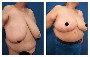 Renuvion Skin Contraction what it Means for You — patient photo