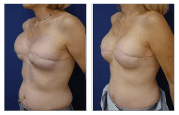 Fat Transfer Following Breast Radiation