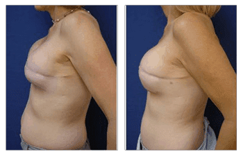 A woman's breast before and after fat transfer surgery.