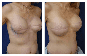 A woman's Fat Transfer breast surgery before and after.