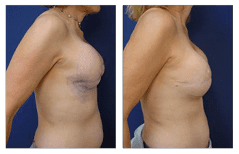 A woman's breast before and after Fat Transfer surgery.
