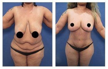 Breast Lift Scars After One Year Breast Lift Scars After One Year