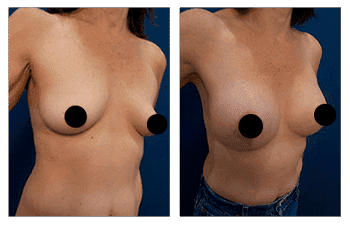 A woman's breasts before and after breast augmentation. A woman's breasts before and after breast augmentation.