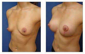 breast lift with implants patient 33 front left view breast lift with implants patient 33 front left view
