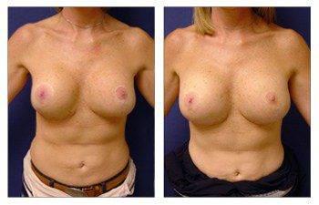 breast-augmentation-revision-patient-17-front(1) breast-augmentation-revision-patient-17-front(1)