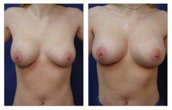 breast-augmentation-revision-patient-5-front breast-augmentation-revision-patient-5-front