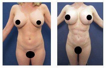breast lift with implants patient 1 front view breast lift with implants patient 1 front view