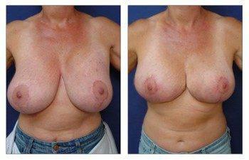 breast-augmentation-revision-patient-2-front breast-augmentation-revision-patient-2-front
