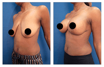 Before and after pictures of a woman's BBL and Breast Augmentation surgery. Before and after pictures of a woman's BBL and Breast Augmentation surgery.