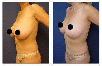 breast lift risks patient 12 front left view breast lift risks patient 12 front left view