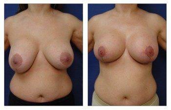 breast augmentation smaller patient 16 front view breast augmentation smaller patient 16 front view