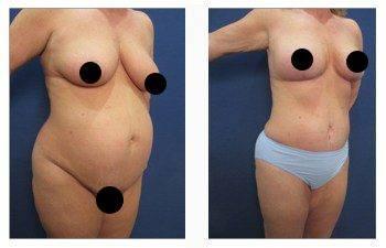 Maximizing Buttock Augmentation — patient photo Maximizing Buttock Augmentation — patient photo