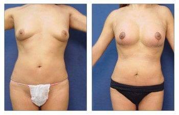 Breast Lift with Implant Augmentation to Increase Breast Mound Size, CPSI, width: 350px; height: 225px; Breast Lift with Implant Augmentation to Increase Breast Mound Size, CPSI, width: 350px; height: 225px;