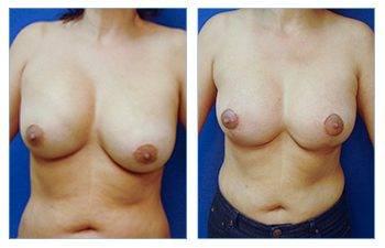 Breast Lift with Implant to Correct Nipple Position Asymmetry Breast Lift with Implant to Correct Nipple Position Asymmetry